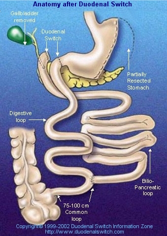 Duodenal Switch Anatomy